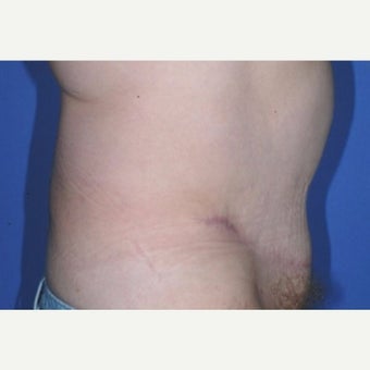 Mom feels so much better after Tummy Tuck and Liposuction of lower flanks. after 2246252