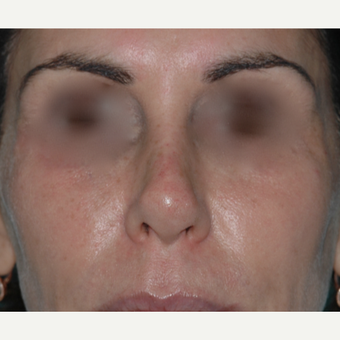 49 year old woman, past rhinoplasty x 2, wanted something "non-surgical" after 3730849
