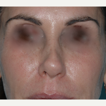 49 year old woman, past rhinoplasty x 2, wanted something "non-surgical" before 3730849