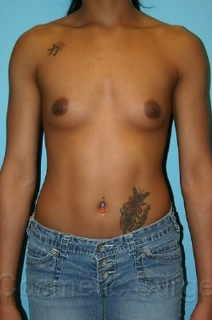 Breast Augmentation before 1059974