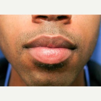 25-34 year old man treated with Lip Reduction before 1863461