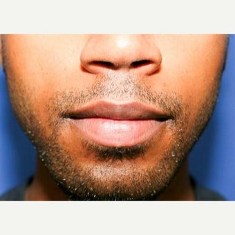 25-34 year old man treated with Lip Reduction after 1863461