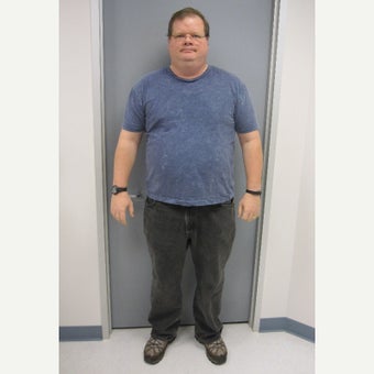 45-54 year old man treated with Gastric Bypass before 1857138