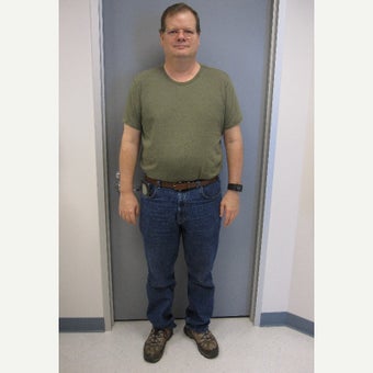 45-54 year old man treated with Gastric Bypass after 1857138