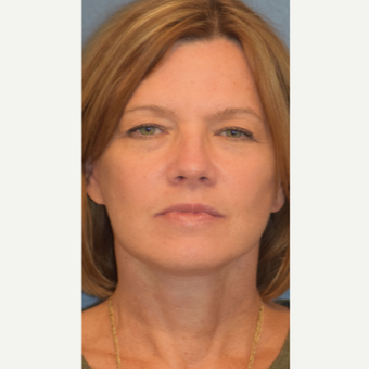 55-64 year old woman treated with Facelift after 3501531