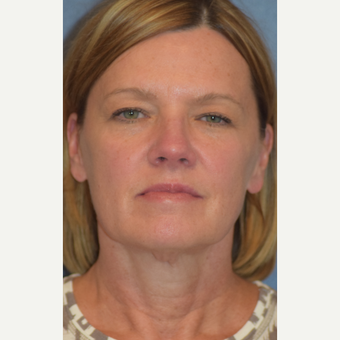 55-64 year old woman treated with Facelift before 3501531