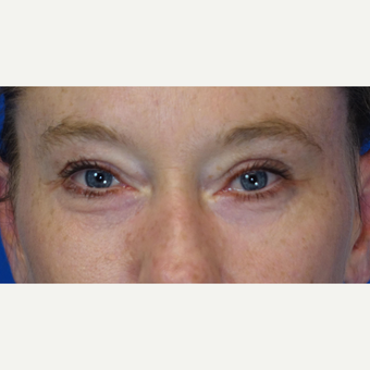 35-44 year old woman treated with Eyelid Surgery after 3304761