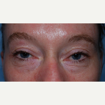 35-44 year old woman treated with Eyelid Surgery before 3304761