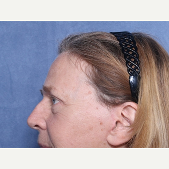 55-64 year old woman treated with Eyelid Surgery (view 2 of 2) after 3180596