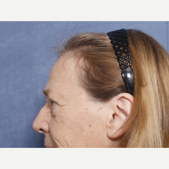 55-64 year old woman treated with Eyelid Surgery (view 2 of 2) before 3180596