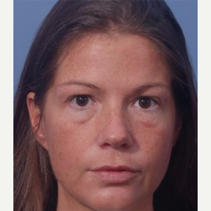 35-44 year old woman treated with Eye Bags Treatment before 3711653