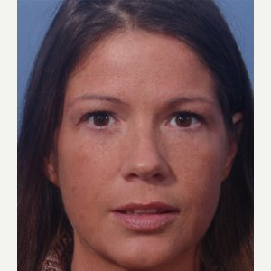 35-44 year old woman treated with Eye Bags Treatment after 3711653