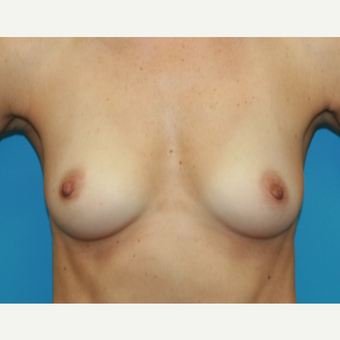 45 year old woman treated with Breast Augmentation before 3482713