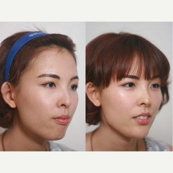 small chin and flat nose, Augmentation by Radiesse filler after 3193494