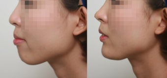 small chin and flat nose, Augmentation by Radiesse filler before 3193494