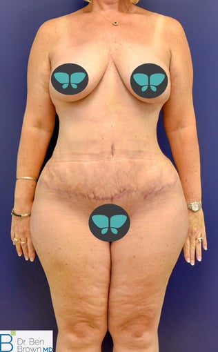 55-64 year old woman treated with Tummy Tuck after 3486855