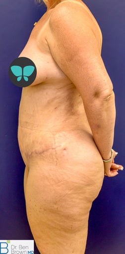 55-64 year old woman treated with Tummy Tuck 3486855