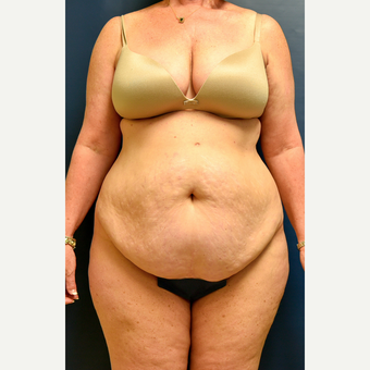 55-64 year old woman treated with Tummy Tuck before 3486855