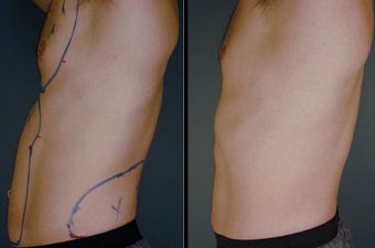 Smart Lipo before 996409