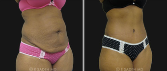 Tummy Tuck after 692776