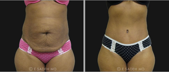 Tummy Tuck before 692776