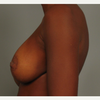 35-44 year old woman treated with Breast Lift with Implants after 3464584