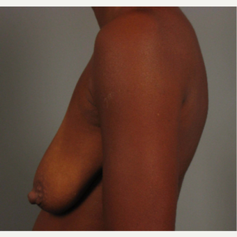 35-44 year old woman treated with Breast Lift with Implants before 3464584