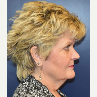 55-64 year old woman treated with Neck Lift before 3188181