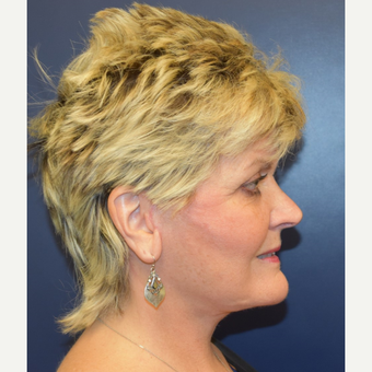 55-64 year old woman treated with Neck Lift after 3188181