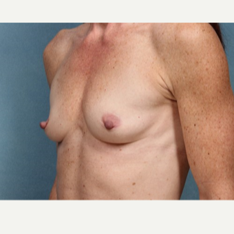 45-54 year old woman treated with Breast Augmentation before 3523800