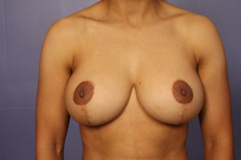 42 yr old Breast Reduction after 1013905