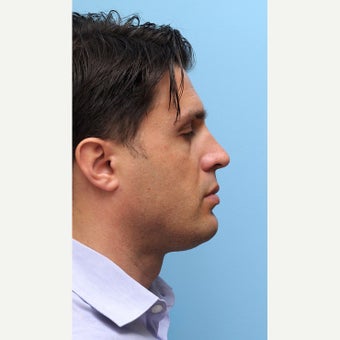 Non Surgcial Chin Augmentation Using Voluma before 1747193
