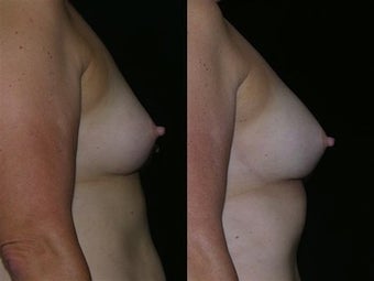 Implant Removal & Fat Grafting Breast Augmentation before 1053856