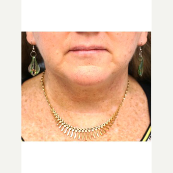 55-64 year old woman treated with Neck Lift after 3653640