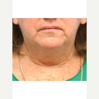 55-64 year old woman treated with Neck Lift before 3653640