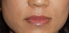 Soft Tissue Fillers Patient after 969765