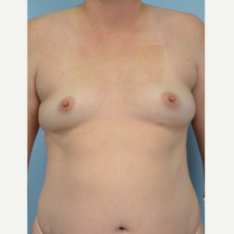 45-54 year old woman treated with Breast Fat Transfer before 3432093