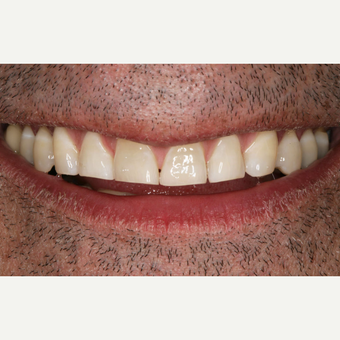 25-34 year old man treated with Porcelain Veneers before 3629632