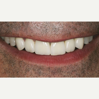 25-34 year old man treated with Porcelain Veneers after 3629632