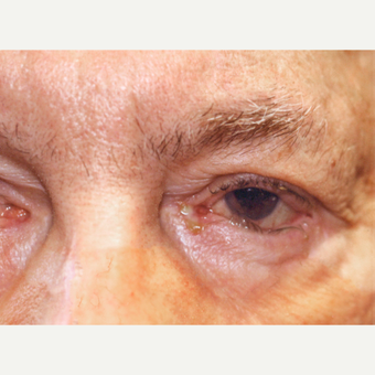 75 and up year old man treated with Eyelid Entropion Repair before 3147969
