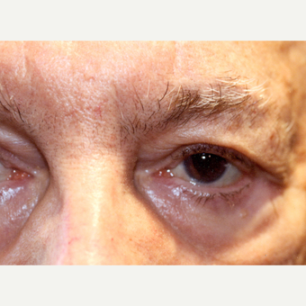 75 and up year old man treated with Eyelid Entropion Repair after 3147969