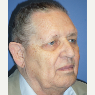75 and up year old man treated with Eyelid Surgery before 3370109