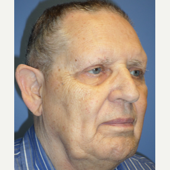 75 and up year old man treated with Eyelid Surgery after 3370109