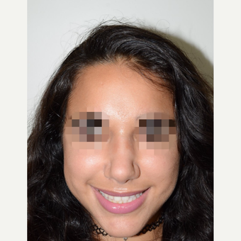 18-24 year old woman treated with Rhinoplasty after 3337938