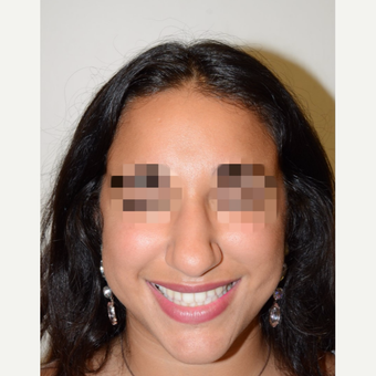 18-24 year old woman treated with Rhinoplasty before 3337938