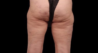 55-64 year old woman treated with Cellfina after 2830960