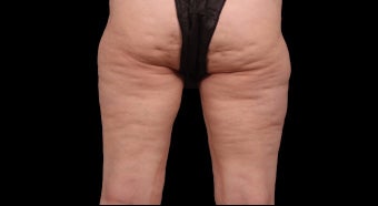 55-64 year old woman treated with Cellfina before 2830960