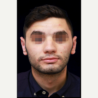 18-24 year old man treated with Ear Lobe Surgery after 3735156
