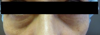 Before and after Restylane to the Tear Troughs before 1143418