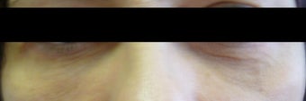 Before and after Restylane to the Tear Troughs after 1143418